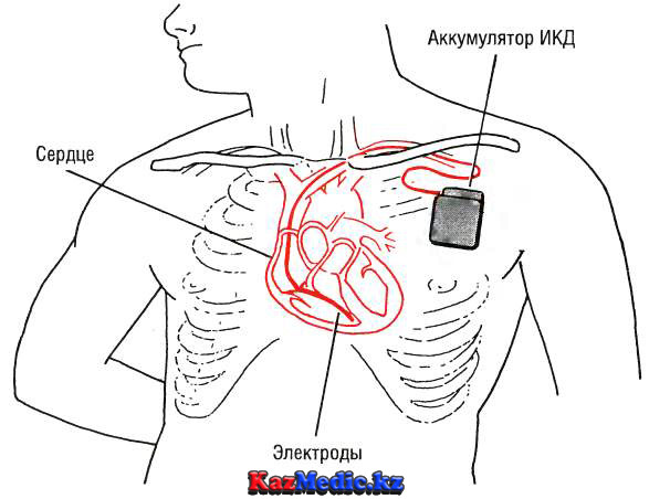 Имплантацияланатын кардиовертер дефибриллятор (ИКД)