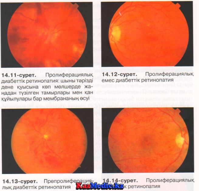 диабеттік ретинопатия