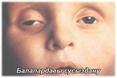Балалардағы сусыздану