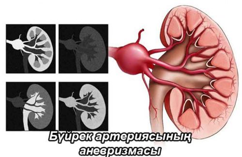 Бүйрек артериясының аневризмасы