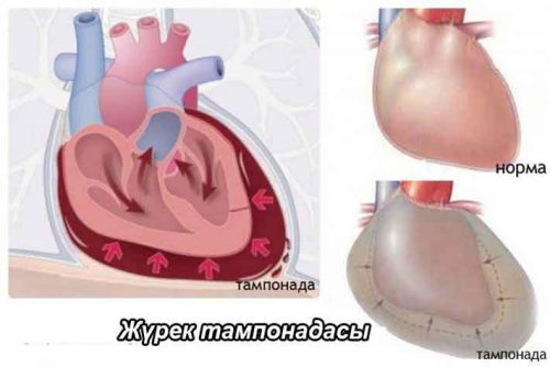 Жүрек жарақаты. Жүрек тампонадасы