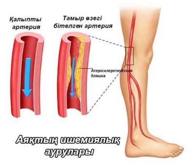 Аяқтың созылмалы ишемиялық ауруы