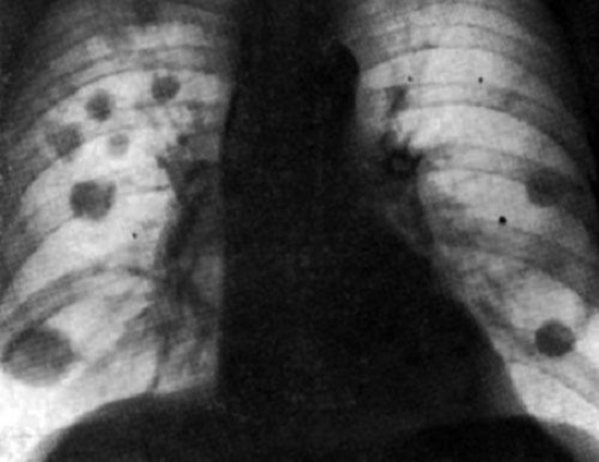 өкпе туберкулезінің рентген суреті