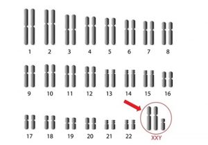 Хромосомның ххy синдромы