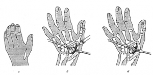 Галеация зақымдануы