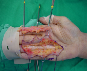 Алақан сүйектерінің диафиздерінің сынығы