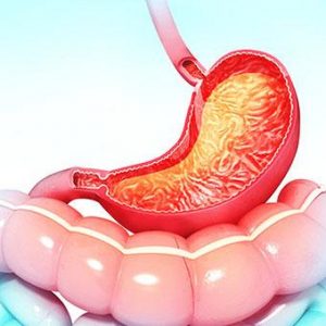 Жедел гастрит