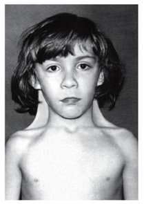 Хромосоманың Х моносомия синдромы (Шершевский-Тернер синдромы, Тернер синдромы,ХО- синдромы)