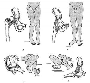 Сан сүйегінің шығулары.