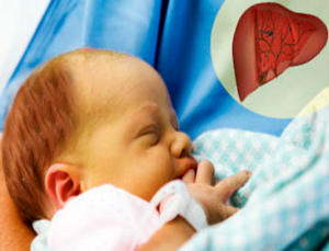 Туа біткен гипотиреоз