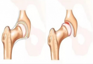 Сан сүйегі сынықтарының емі