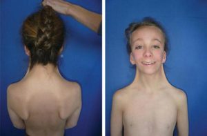 Хромосоманың Х моносомия синдромы (Шершевский-Тернер синдромы, Тернер синдромы,ХО- синдромы)