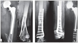 Сан диафизі сынықтары.