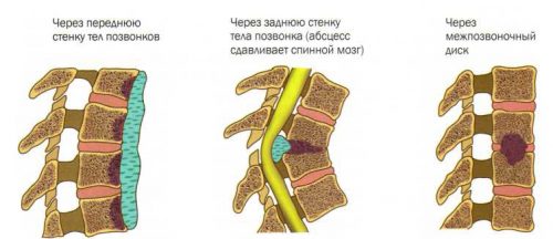 Туберкулезді спондилит