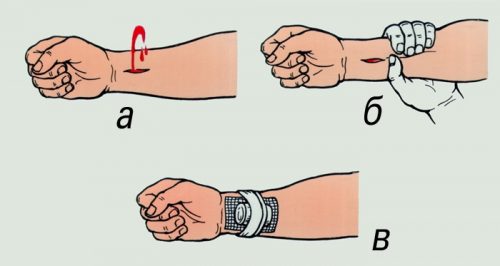 Қанды уақытша тоқтату әдістері.