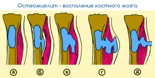 Жедел гематогенді (қан арқылы) остеомиелит