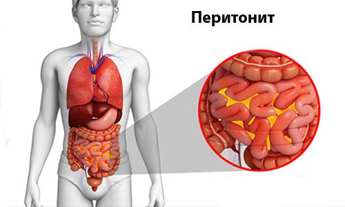 Іріңді перитонит.