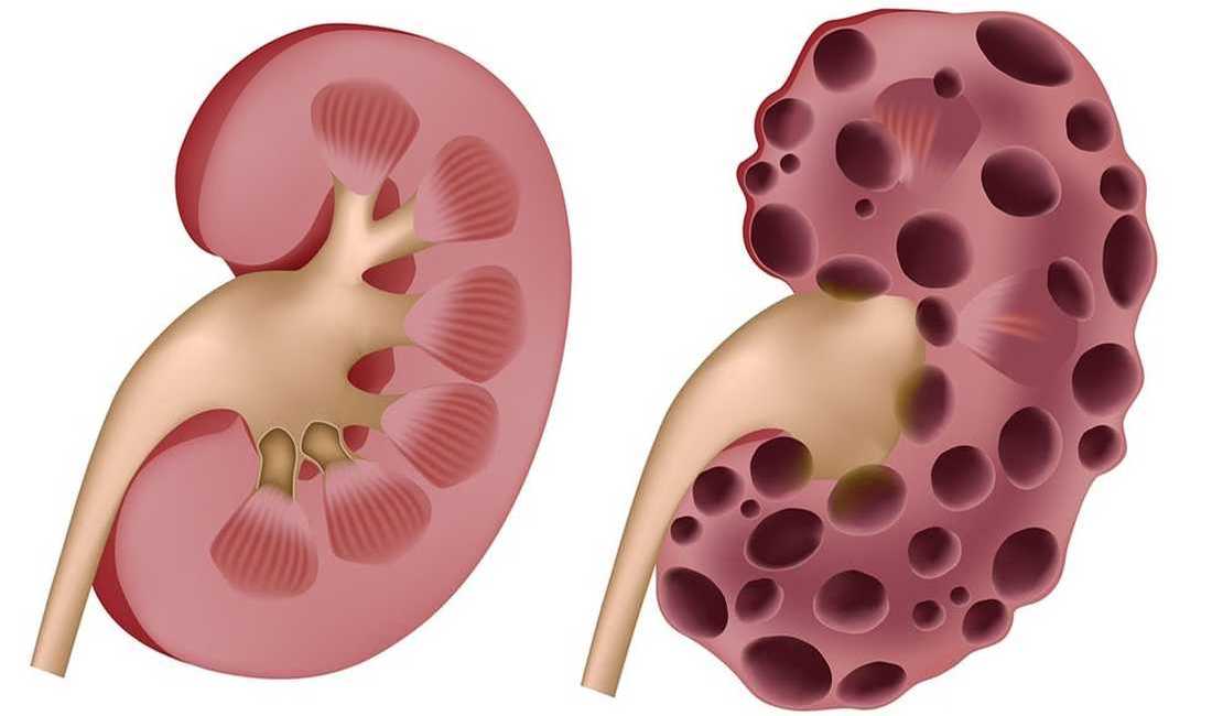 влияние алкоголя на почки. влияние наркотиков на почки. почка пьющего человека. влияние алкоголя на почки. симптомы поликистоза почек.