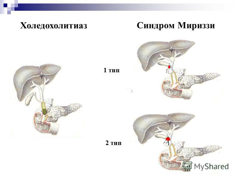 Синдром мириззи презентация