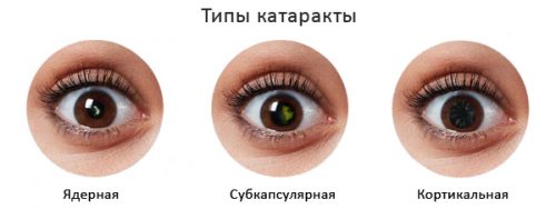Катаракта