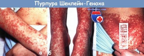 Шенлейн–Генох пурпурасы