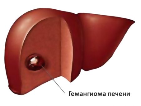 Бауыр гемангиомасы