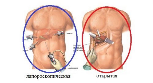 Холецистэктомиядан кейінгі синдром