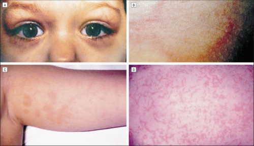 TRAPS-синдром (TNF Receptor-Associated Periodic Syndrome)