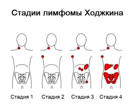 Лимфогранулематоз