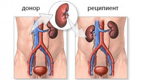 Бүйрек трансплантациясы